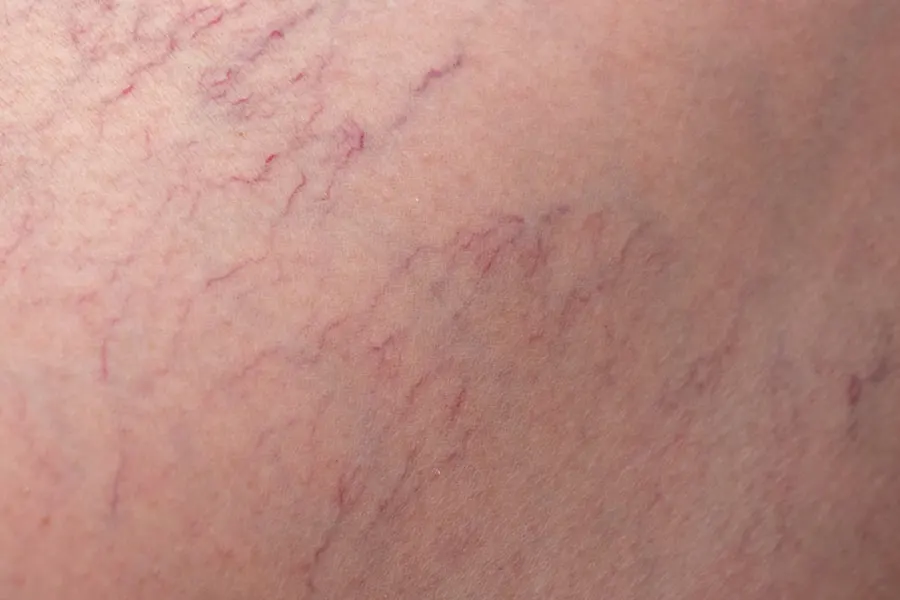 Laserowe zamykanie naczynek na nogach