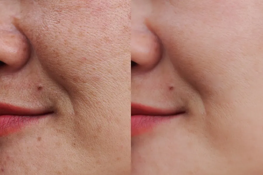 Usuwanie przebarwień skóry ALMA HARMONY Dye